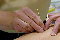 accupuncture by experts in India
