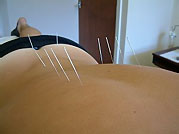 accupuncture treatment for back problems