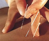 accupuncture treatment in India