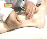 Accupuncture treatment